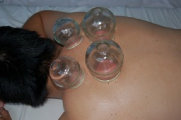 Cupping