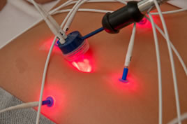 laseracupunctuur