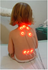 Laseracupunctuur